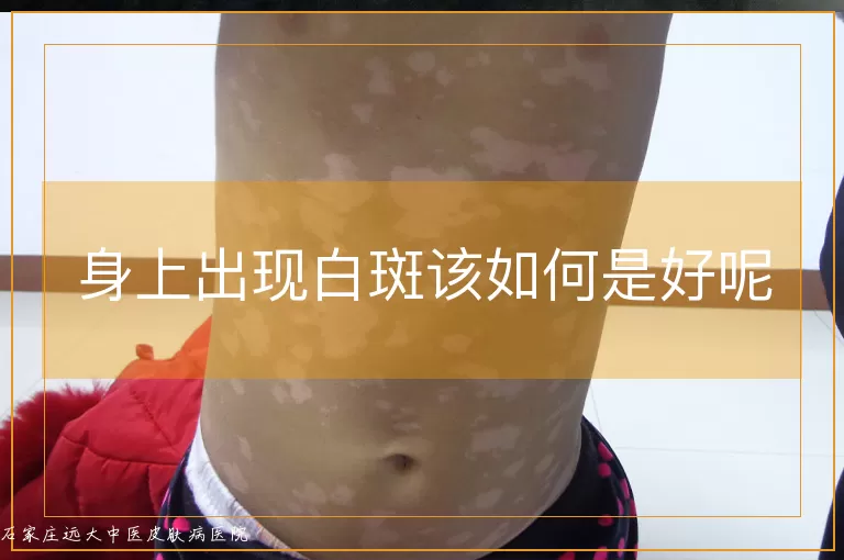 身上出现白斑该如何是好呢