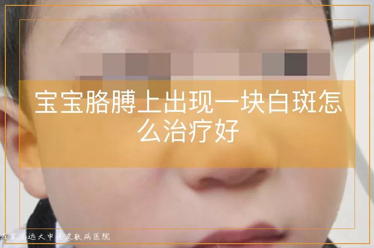 宝宝胳膊上出现一块白斑怎么治疗好