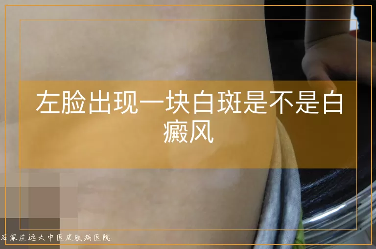 左脸出现一块白斑是不是白癜风