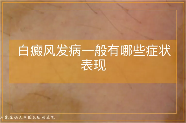 白癜风发病一般有哪些症状表现