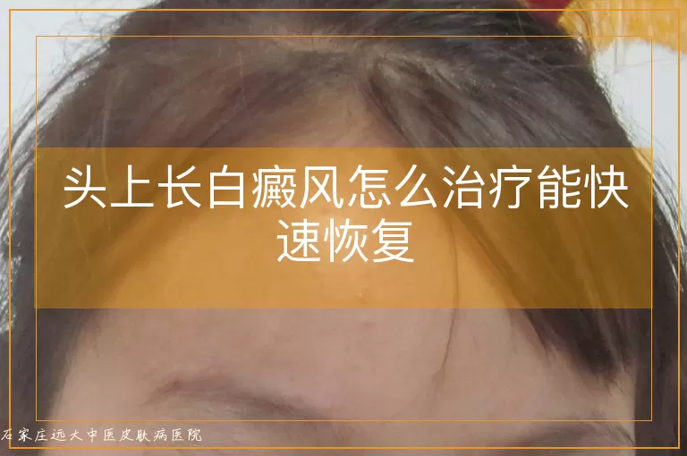 头上长白癜风怎么治疗能快速恢复