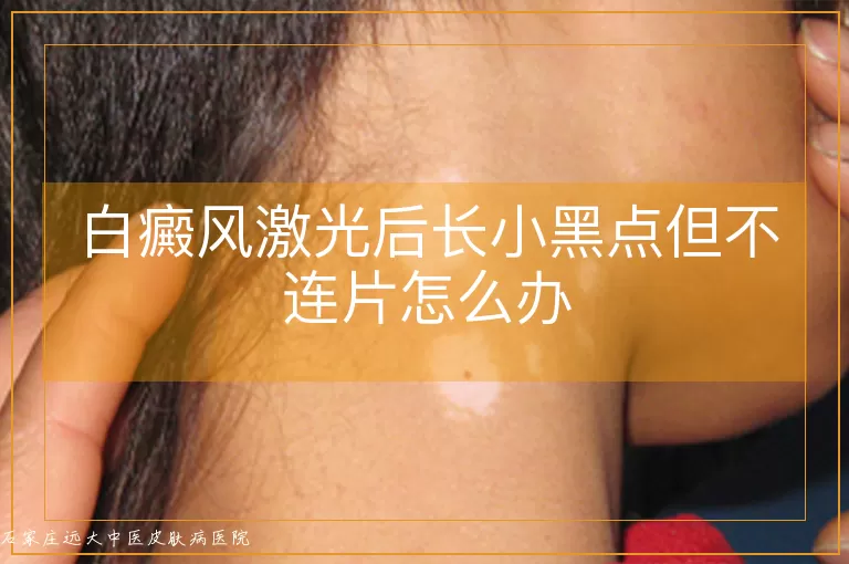 白癜风激光后长小黑点但不连片怎么办