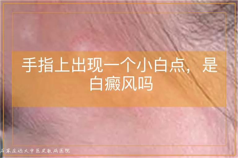 手指上出现一个小白点，是白癜风吗