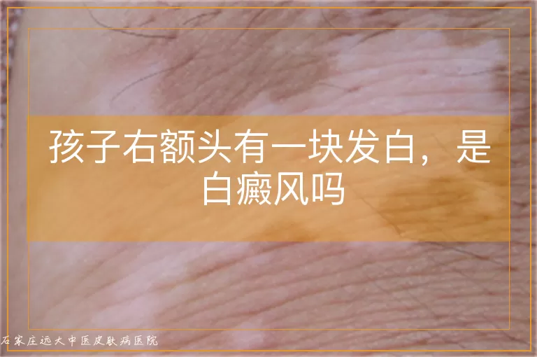 孩子右额头有一块发白,是白癜风吗