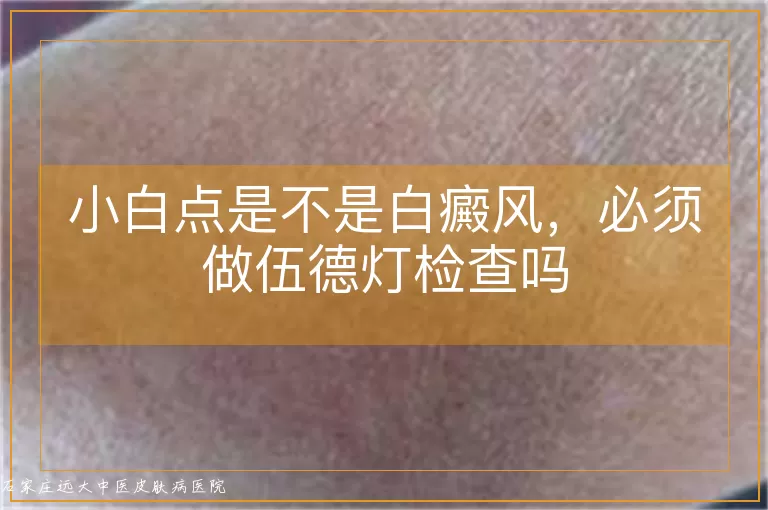 小白点是不是白癜风,必须做伍德灯检查吗