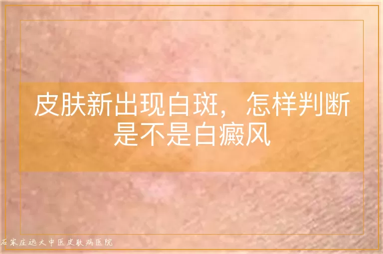 皮肤新出现白斑,怎样判断是不是白癜风