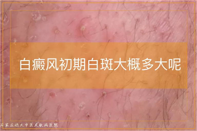 白癜风初期白斑大概多大呢