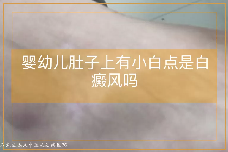 婴幼儿肚子上有小白点是白癜风吗