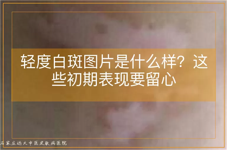 轻度白斑图片是什么样?这些初期表现要留心
