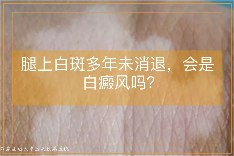 腿上白斑多年未消退,会是白癜风吗?