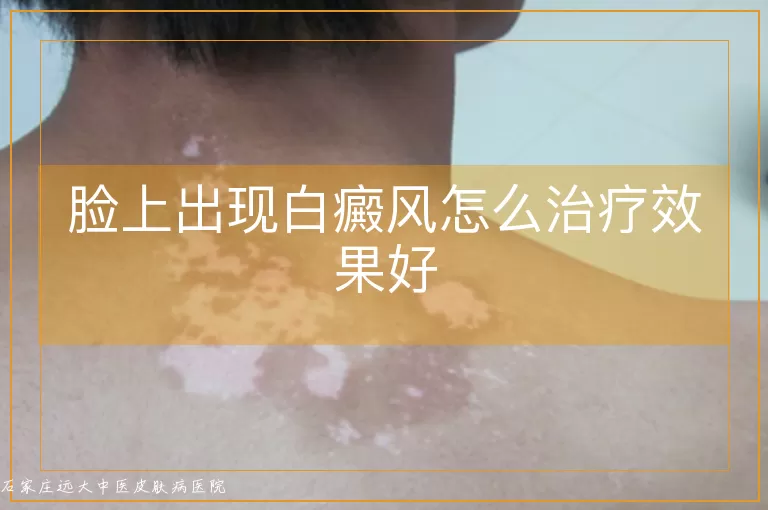 脸上出现白癜风怎么治疗效果好