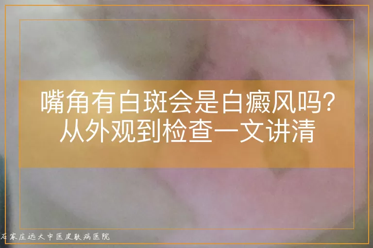 嘴角有白斑会是白癜风吗？从外观到检查一文讲清