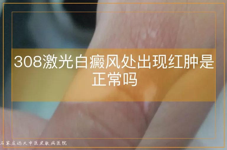 308激光白癜风处出现红肿是正常吗