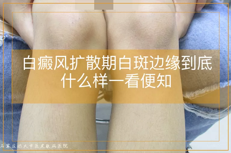 白癜风扩散期白斑边缘到底什么样一看便知