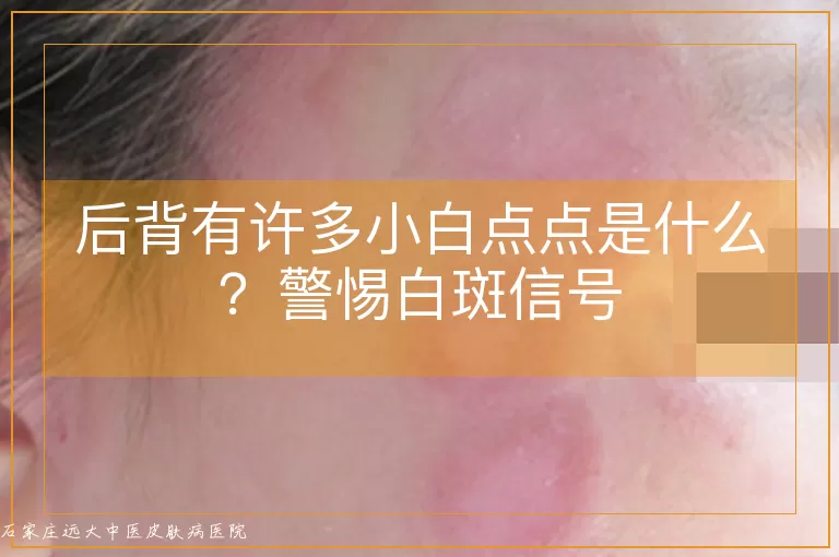 后背有许多小白点点是什么?警惕白斑信号