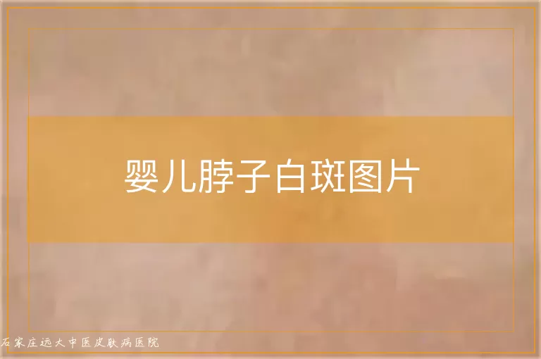 婴儿脖子白斑图片