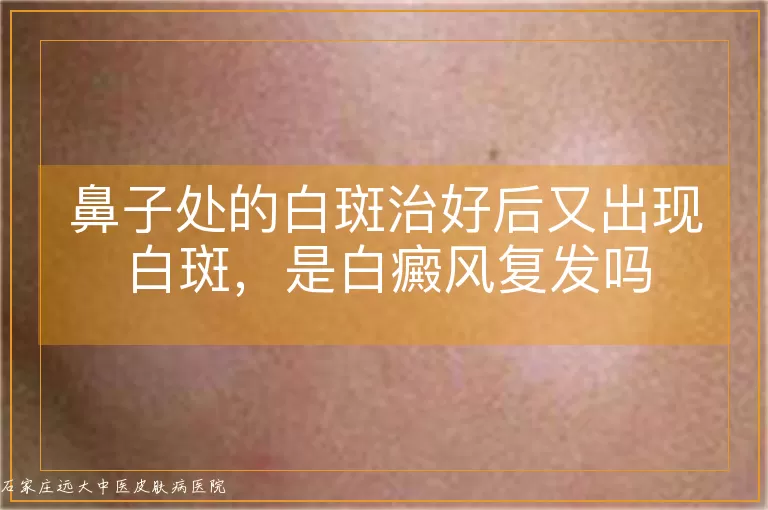 鼻子处的白斑治好后又出现白斑,是白癜风复发吗