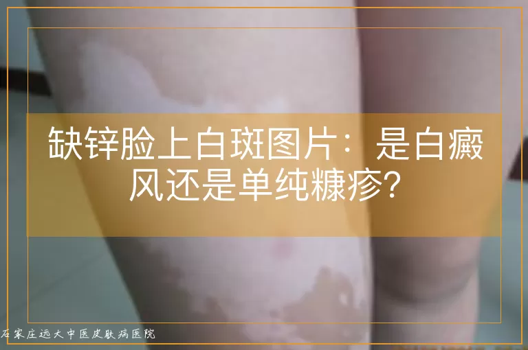缺锌脸上白斑图片:是白癜风还是单纯糠疹?