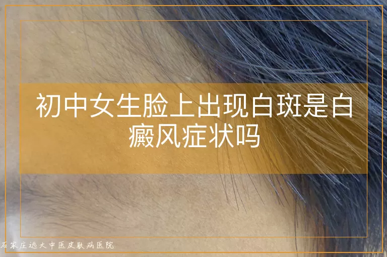初中女生脸上出现白斑是白癜风症状吗