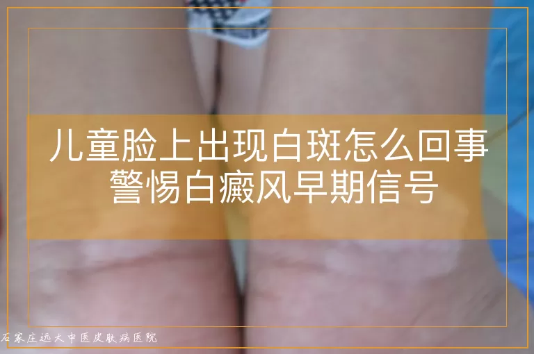 儿童脸上出现白斑怎么回事 警惕白癜风早期信号
