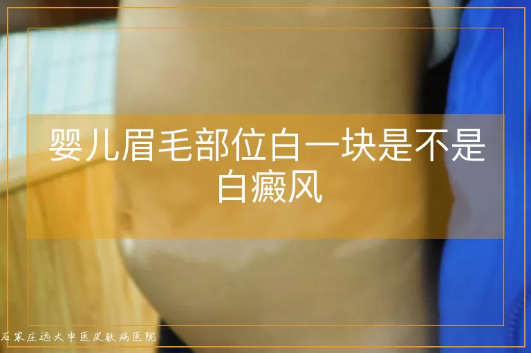 婴儿眉毛部位白一块是不是白癜风