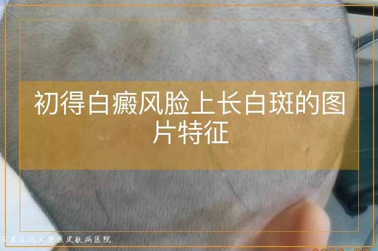 初得白癜风脸上长白斑的图片特征