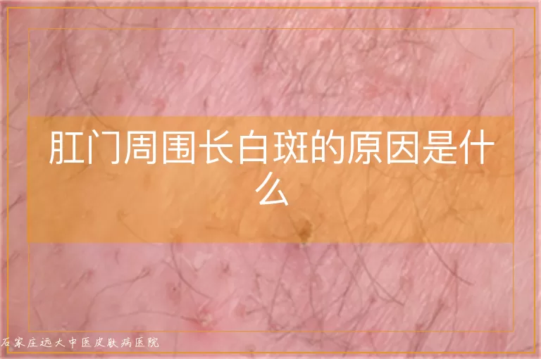 肛门周围长白斑的原因是什么