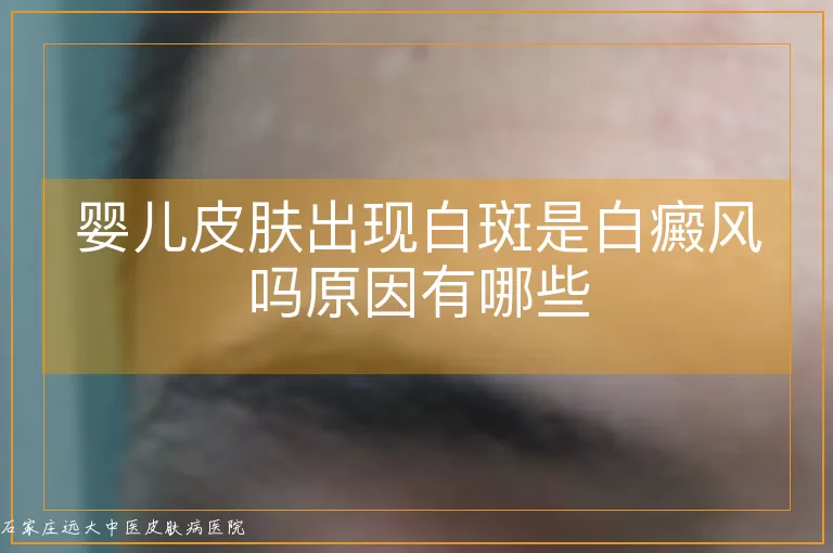 婴儿皮肤出现白斑是白癜风吗原因有哪些