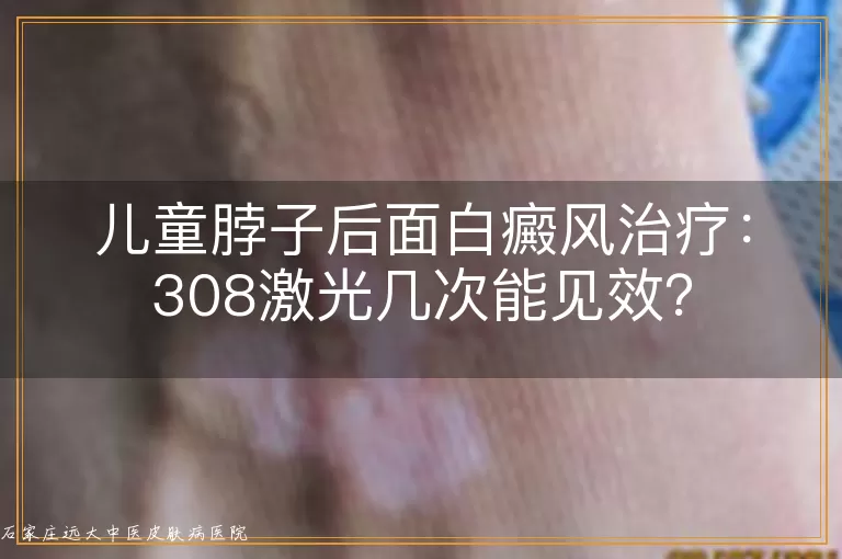 儿童脖子后面白癜风治疗：308激光几次能见效？