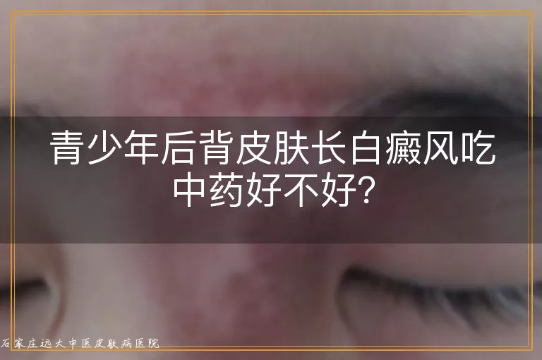 青少年后背皮肤长白癜风吃中药好不好？