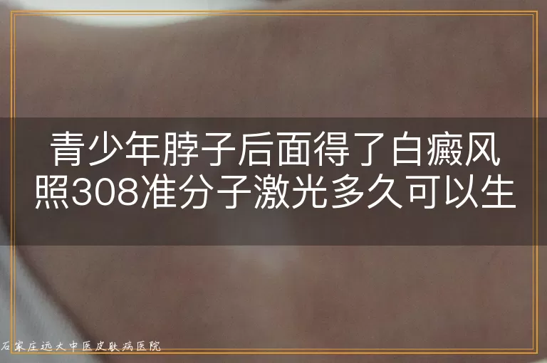 青少年脖子后面得了白癜风照308准分子激光多久可以生效