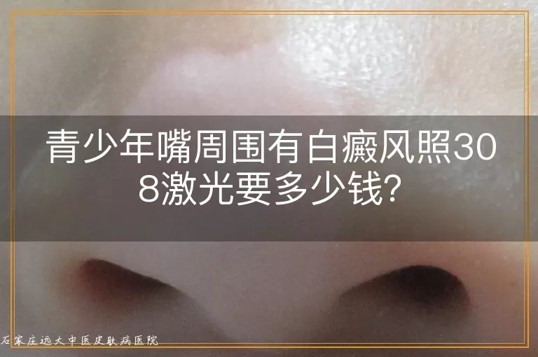 青少年嘴周围有白癜风照308激光要多少钱？