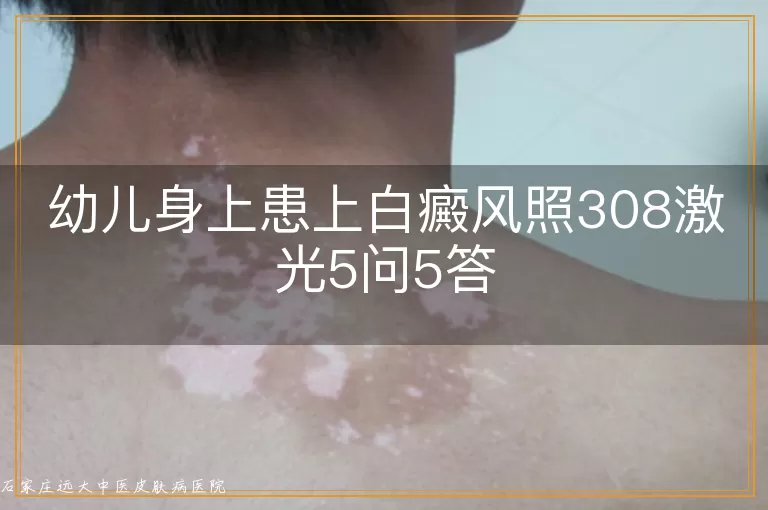 幼儿身上患上白癜风照308激光5问5答
