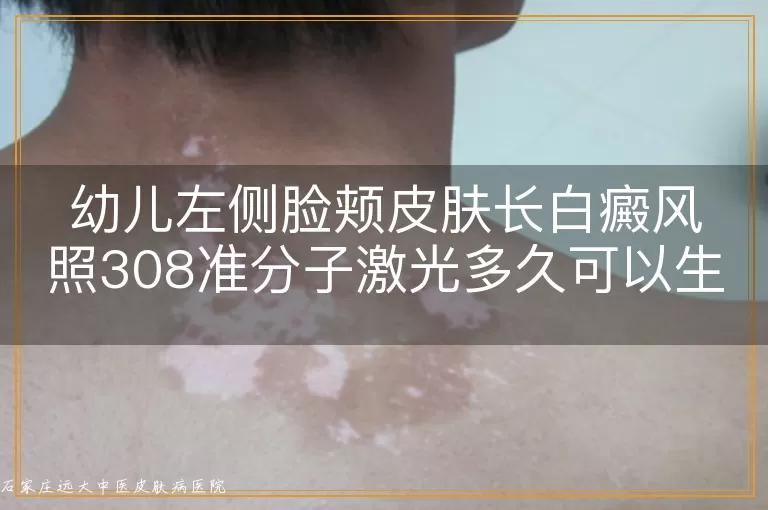 幼儿左侧脸颊皮肤长白癜风照308准分子激光多久可以生效