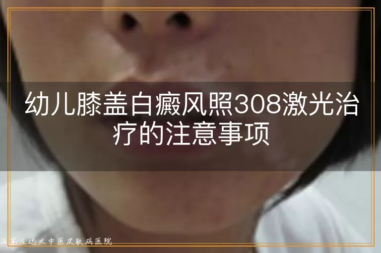 幼儿膝盖白癜风照308激光治疗的注意事项