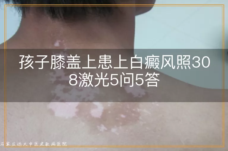 孩子膝盖上患上白癜风照308激光5问5答