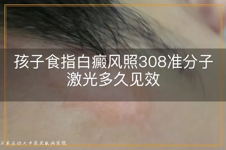 孩子食指白癜风照308准分子激光多久见效