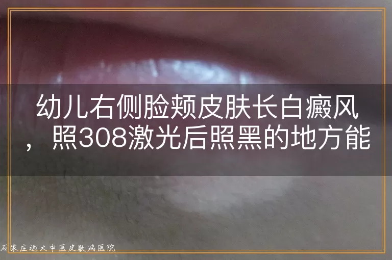 幼儿右侧脸颊皮肤长白癜风，照308激光后照黑的地方能恢复吗？