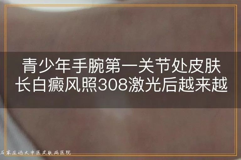 青少年手腕第一关节处皮肤长白癜风照308激光后越来越明显,怎么回事?
