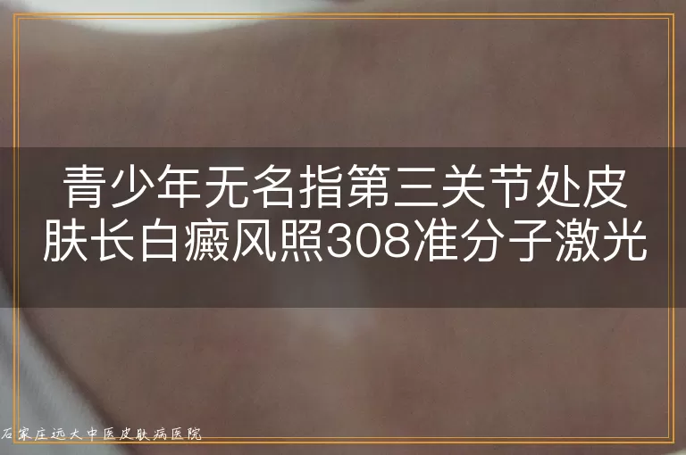 青少年无名指第三关节处皮肤长白癜风照308准分子激光效果如何