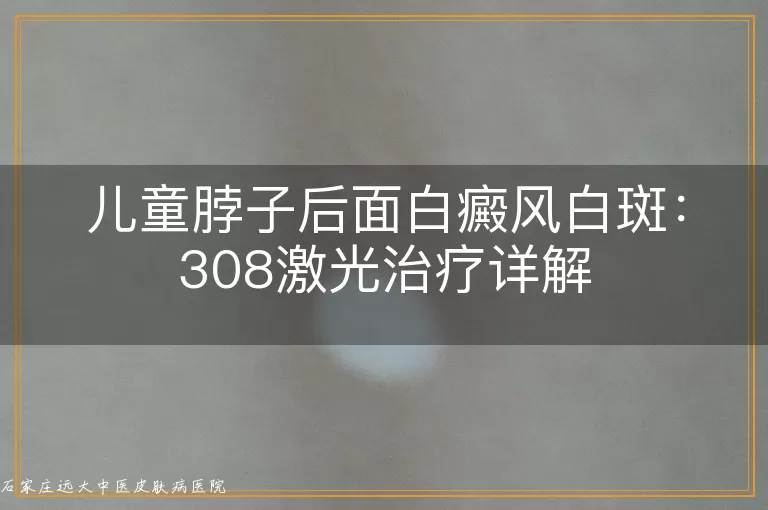 儿童脖子后面白癜风白斑：308激光治疗详解