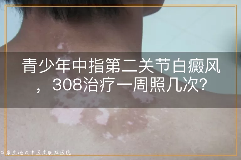 青少年中指第二关节白癜风，308治疗一周照几次？