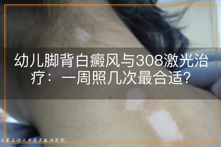 幼儿脚背白癜风与308激光治疗：一周照几次最合适？