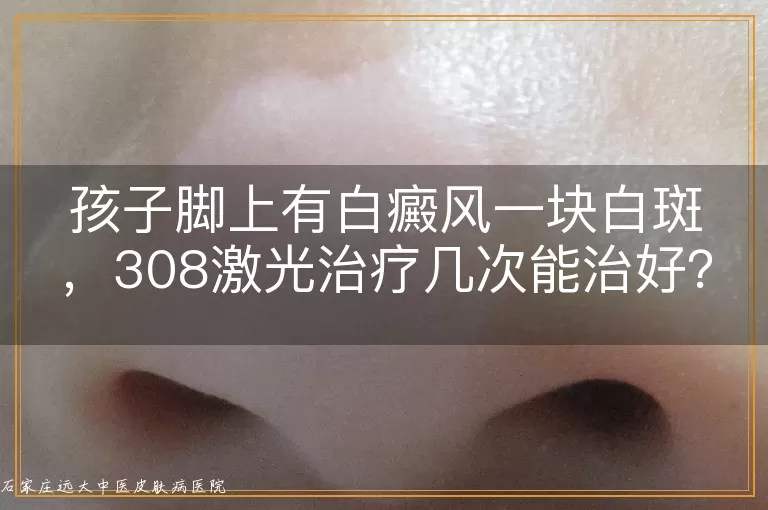 孩子脚上有白癜风一块白斑，308激光治疗几次能治好？