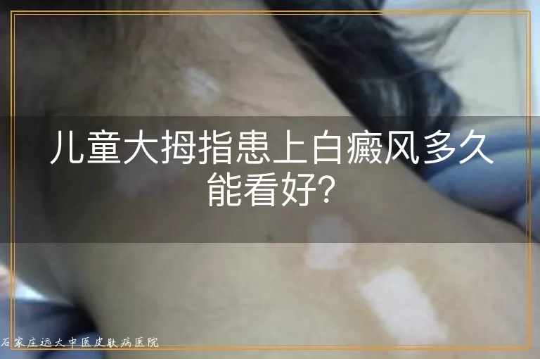 儿童大拇指患上白癜风多久能看好?