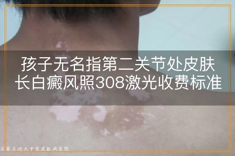 孩子无名指第二关节处皮肤长白癜风照308激光收费标准详解