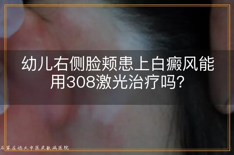 幼儿右侧脸颊患上白癜风能用308激光治疗吗？