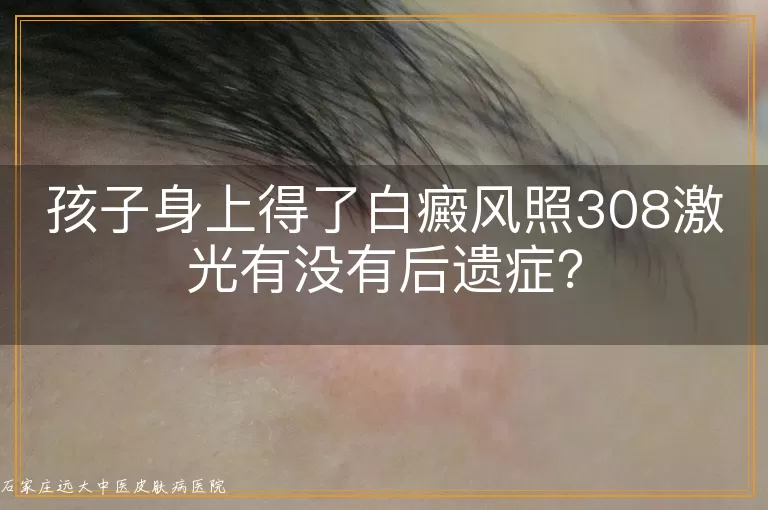 孩子身上得了白癜风照308激光有没有后遗症？