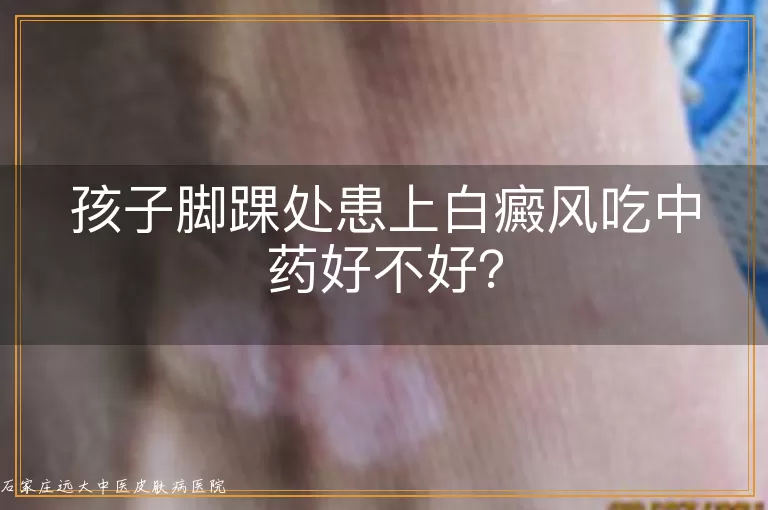 孩子脚踝处患上白癜风吃中药好不好？