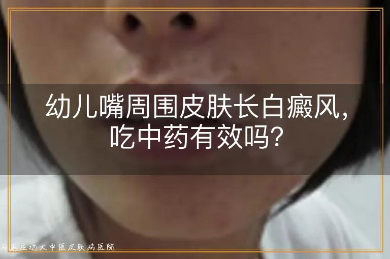 幼儿嘴周围皮肤长白癜风，吃中药有效吗？
